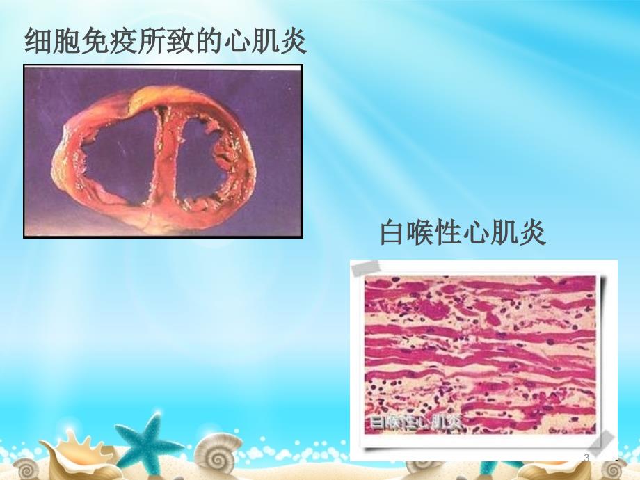 内护心肌炎病人的护理ppt课件.ppt_第3页