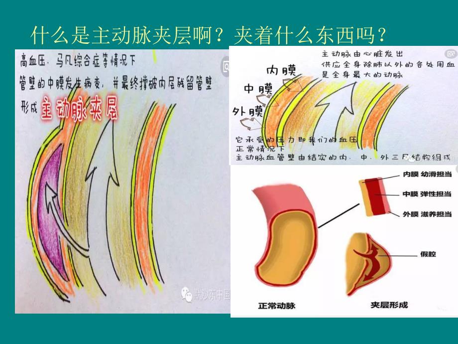 主动脉夹层的病例讨论.ppt_第3页