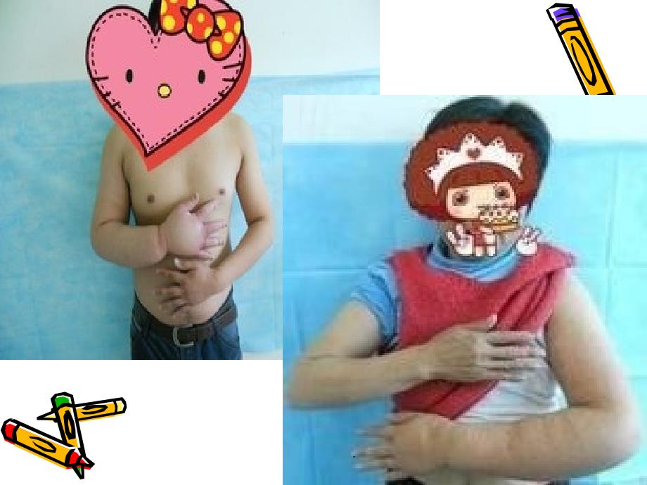 乳腺癌术后淋巴水肿PPT演示课件.ppt_第3页
