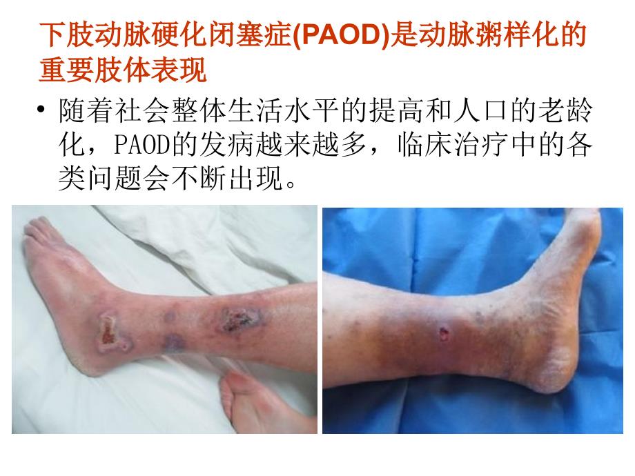 下肢动脉硬化闭塞症护理查房课件.ppt_第2页
