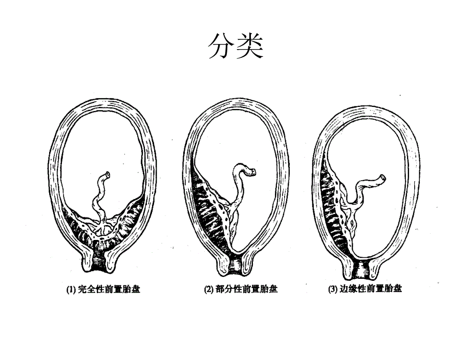 前置胎盘护理PPT课件.ppt_第3页
