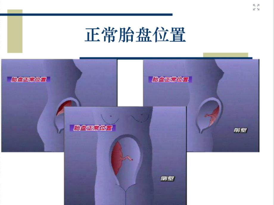 前置胎盘的护理ppt课件.ppt_第2页