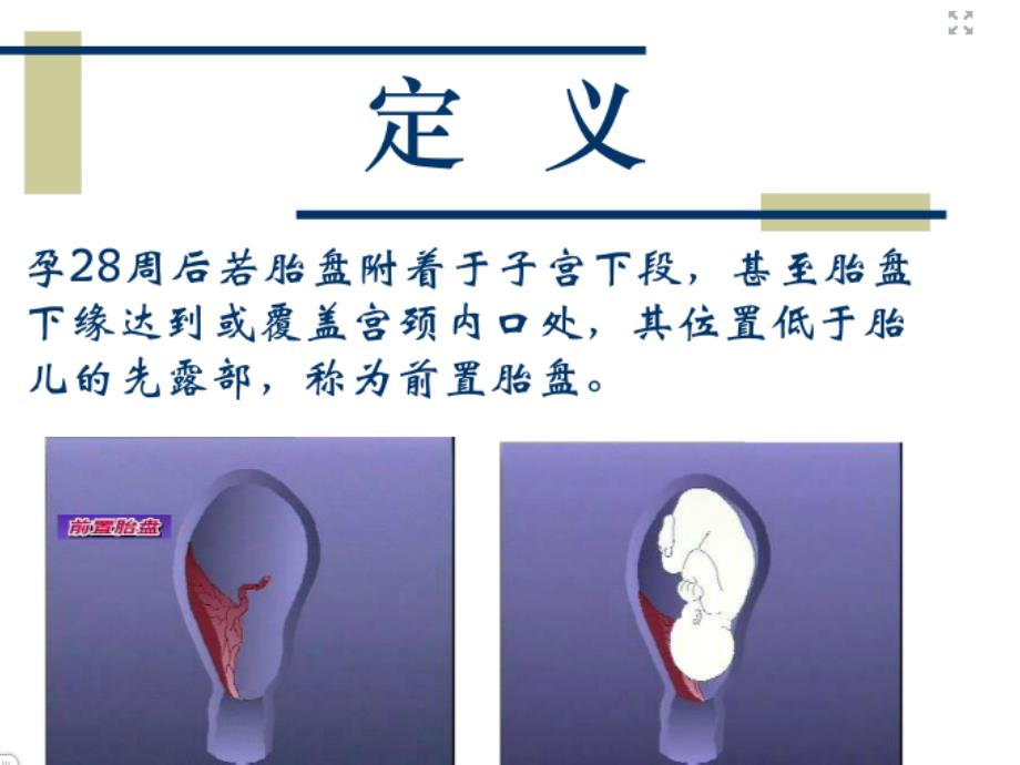 前置胎盘的护理ppt课件.ppt_第3页