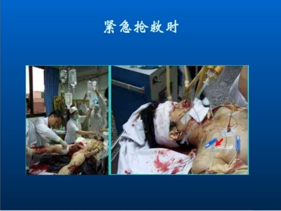 中心静脉置管术PPT课件.ppt_第3页