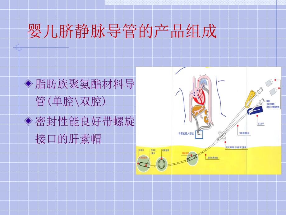 婴儿脐静脉导管课件.ppt_第2页