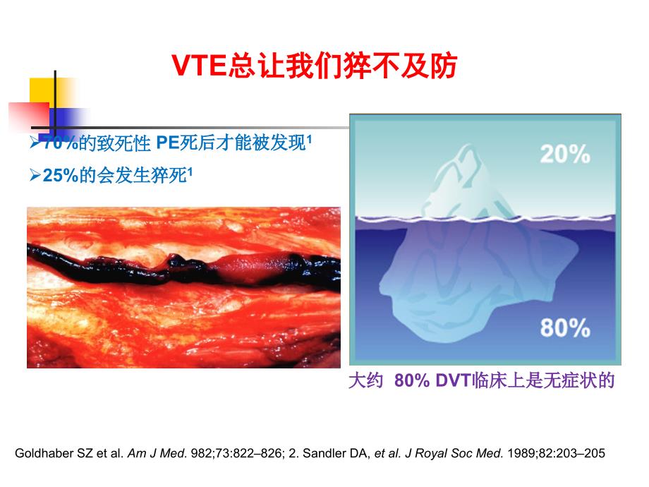 下肢深静脉血栓讲课.ppt_第3页