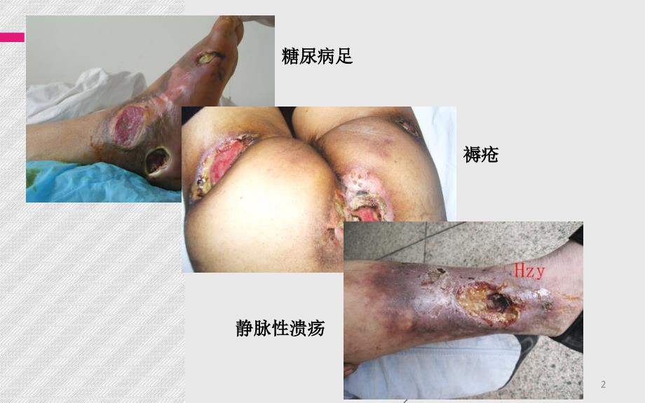 优质课件慢性难愈合创面最近进展.ppt_第2页