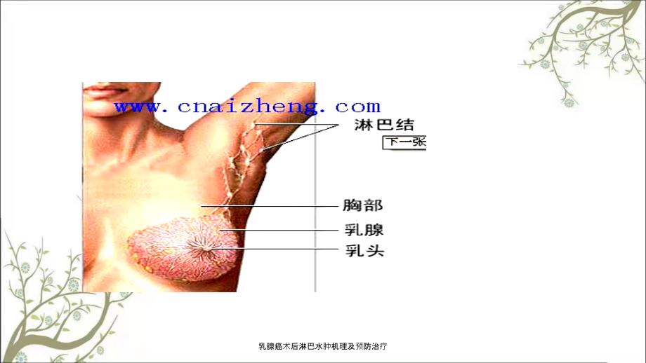 乳腺癌术后淋巴水肿机理及预防治疗.ppt_第3页