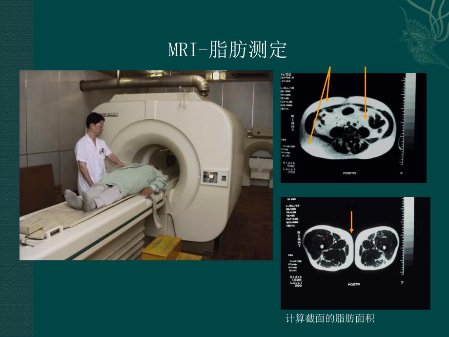 代谢综合征的护理ppt课件.ppt_第3页
