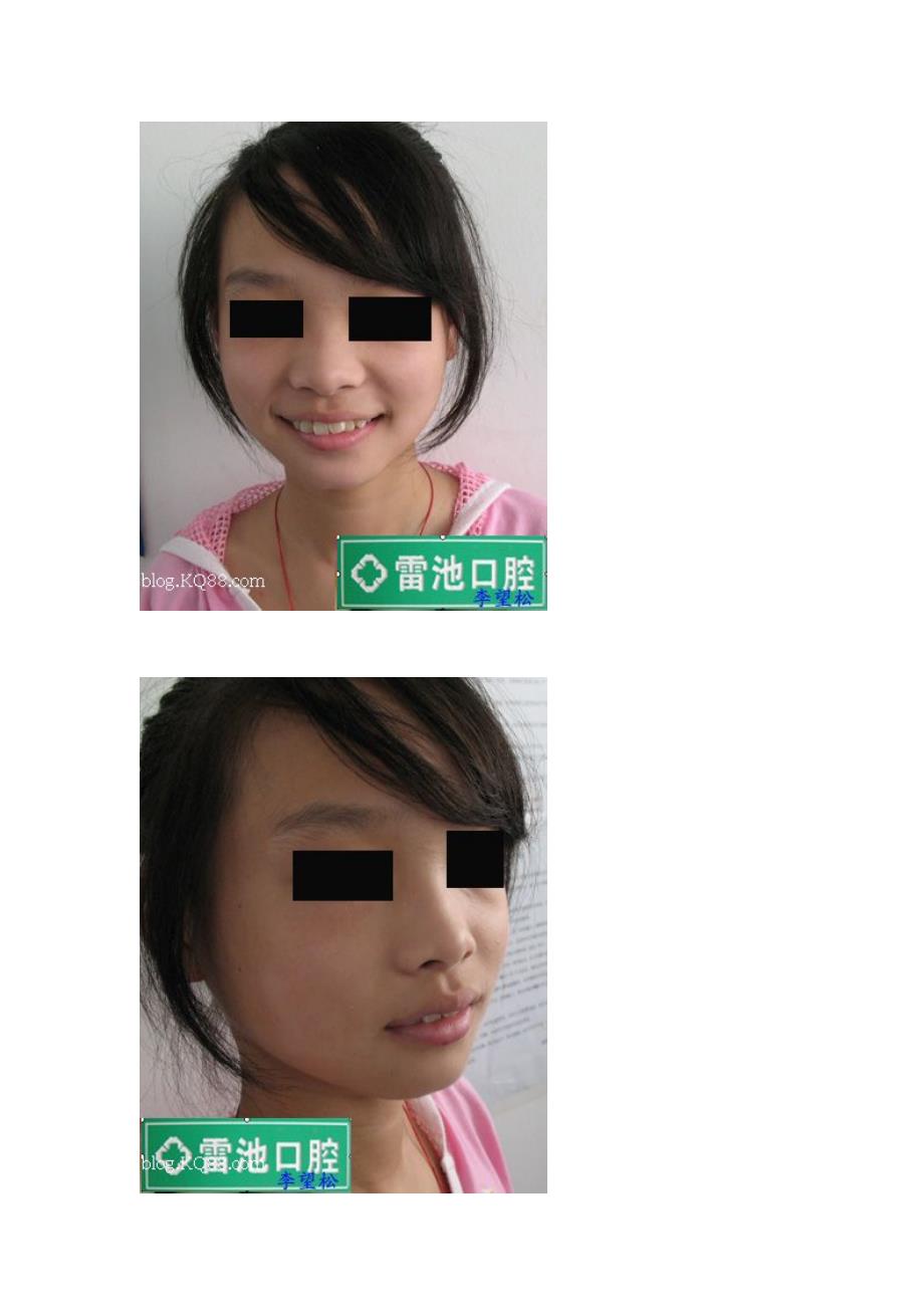 口腔医学总结两例切牙埋伏阻生正畸病例的思考李望松.doc_第2页