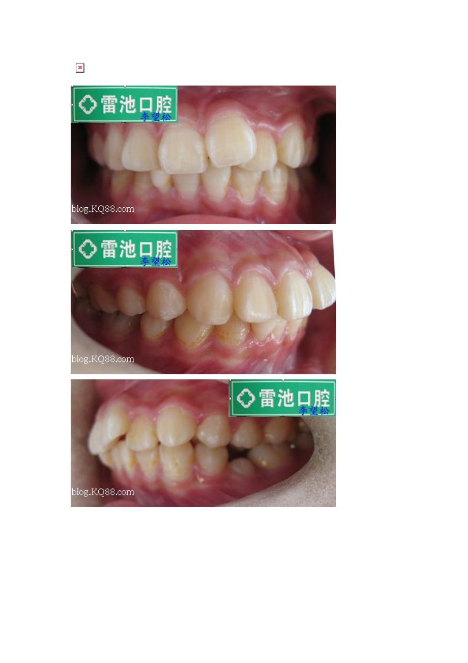 口腔医学总结两例切牙埋伏阻生正畸病例的思考李望松.doc_第3页
