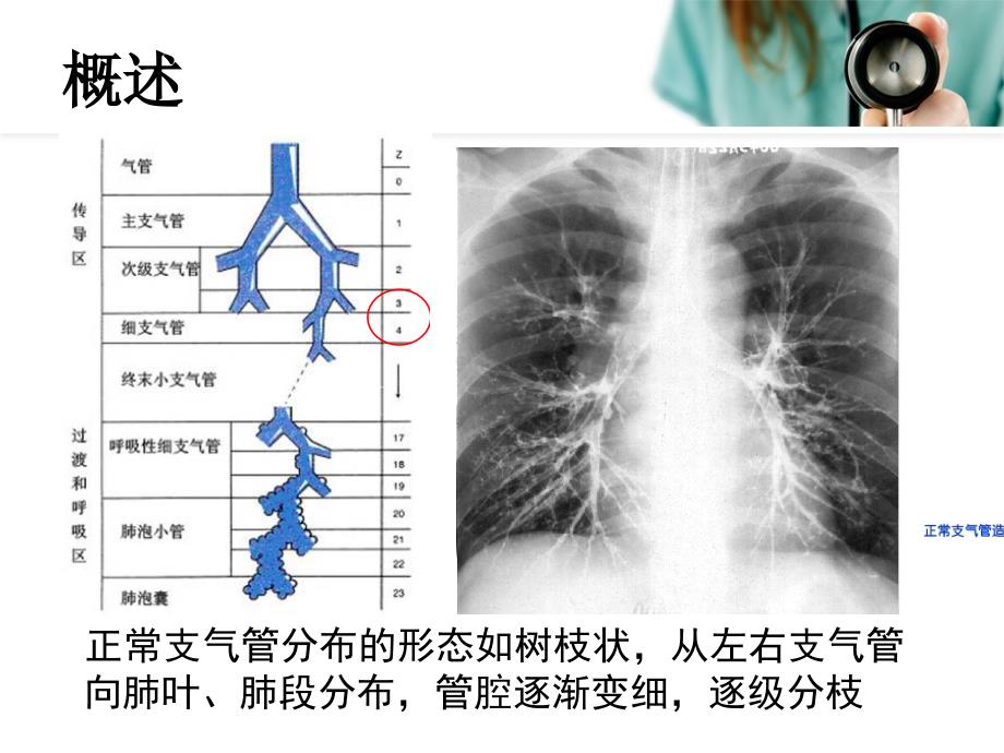 儿童支气管扩张PPT课件.ppt_第3页