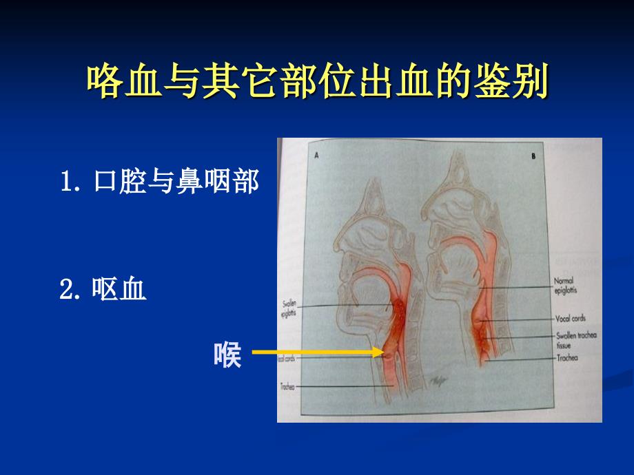 咯血ppt医学课件.ppt_第3页