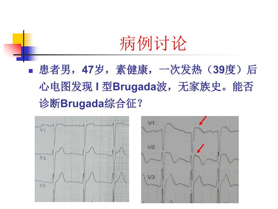 北大课件Brugada综合症.ppt_第3页