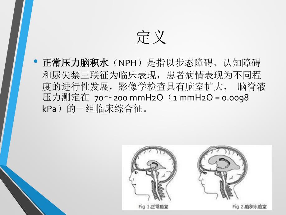 中国特发性正常压力脑积水诊治专家共识ppt课件.ppt_第2页