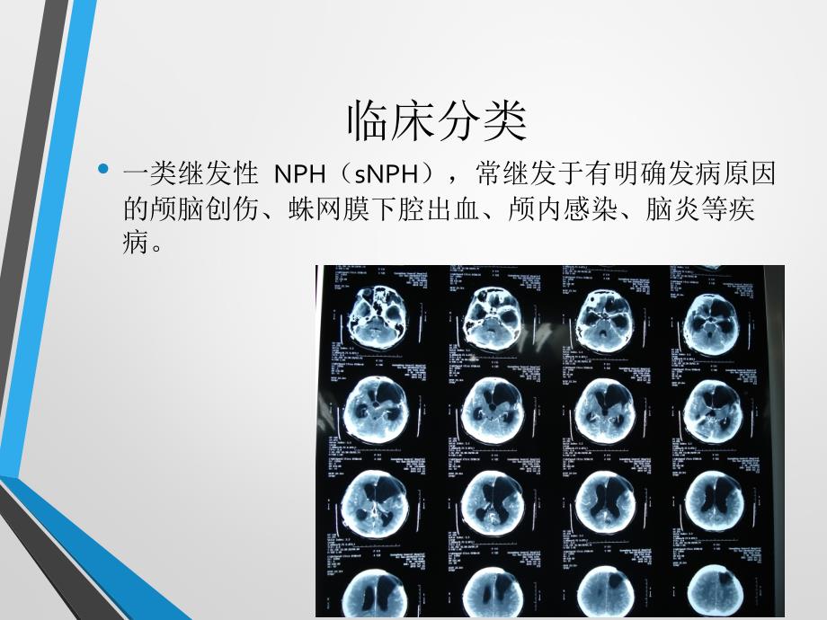 中国特发性正常压力脑积水诊治专家共识ppt课件.ppt_第3页