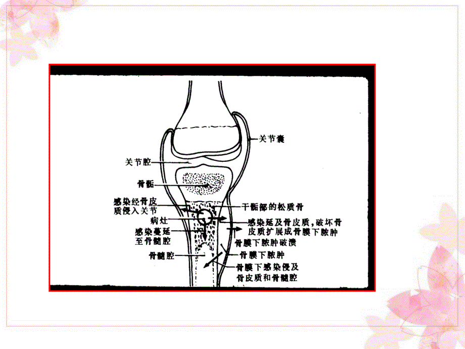 化脓性骨髓炎1ppt课件.ppt_第3页