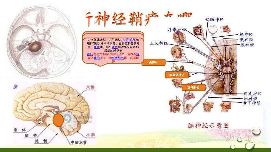 听神经鞘瘤个案查房.pptx_第3页