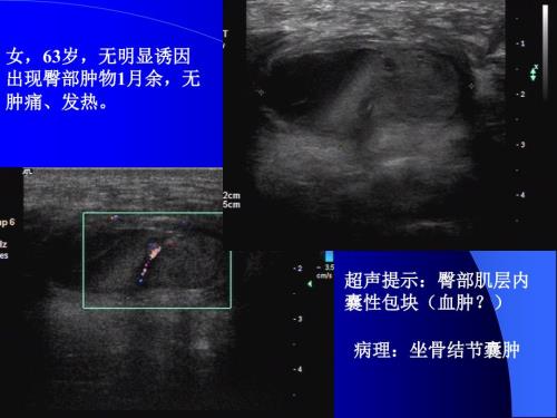 坐骨结节囊肿PPT课件.ppt