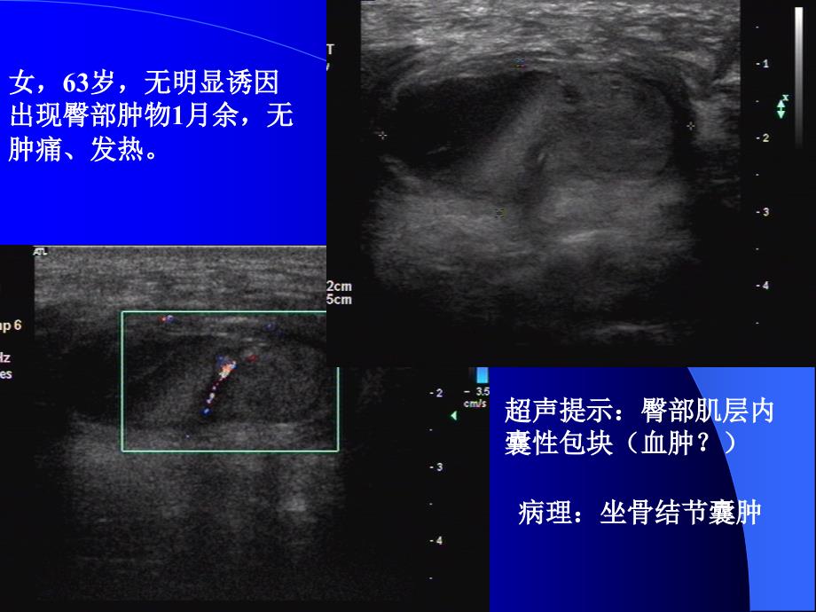 坐骨结节囊肿PPT课件.ppt_第1页