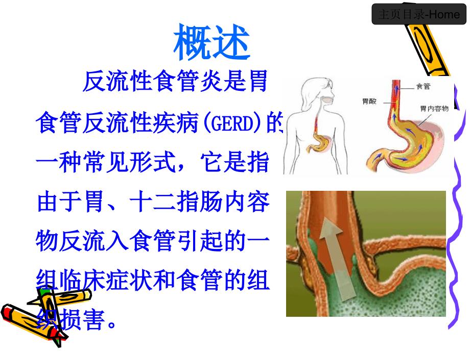 反流性食管炎课件.ppt_第3页