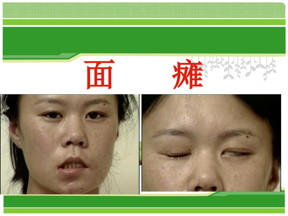 中医面瘫课件.ppt_第1页