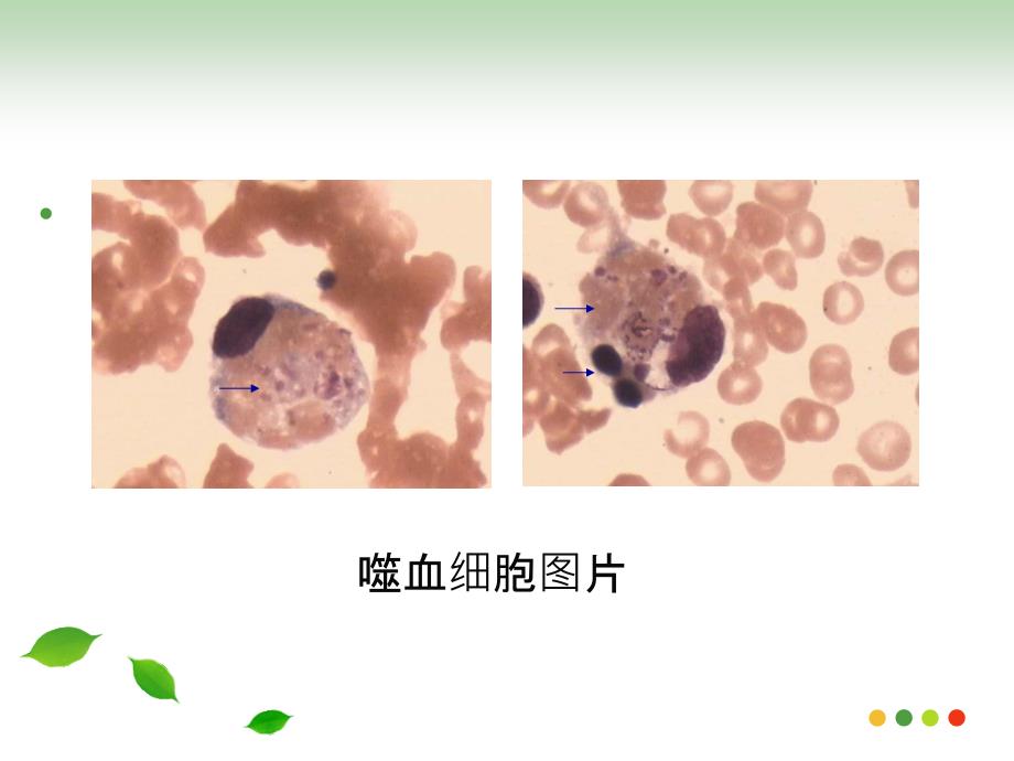 噬血细胞综合征HPS.ppt_第3页