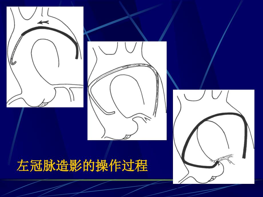 冠脉造影术基础及指引导管选择.ppt_第2页