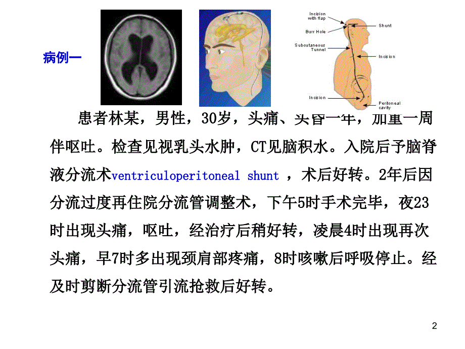 临床颅内压增高ppt课件.ppt_第2页