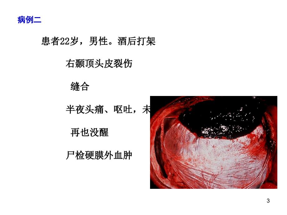 临床颅内压增高ppt课件.ppt_第3页