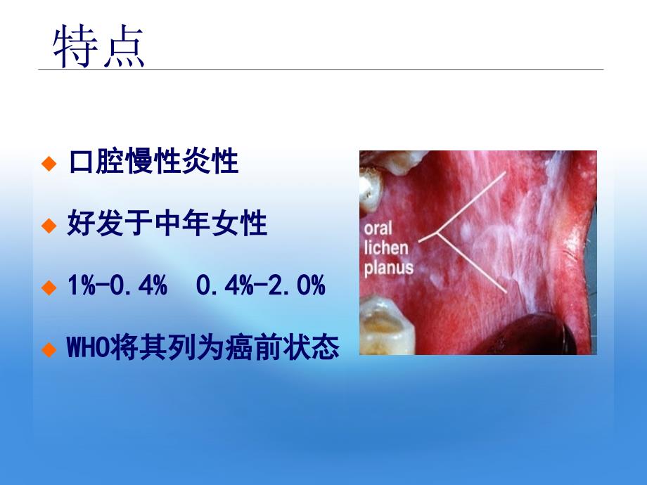 口腔扁平苔藓PPT课件.ppt_第2页