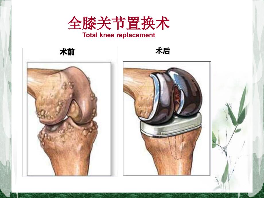 全膝关节置换术后护理PPT.ppt_第3页