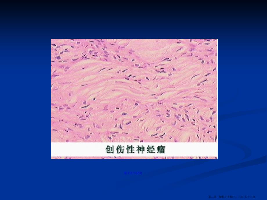 创伤神经瘤学习教案.pptx_第2页