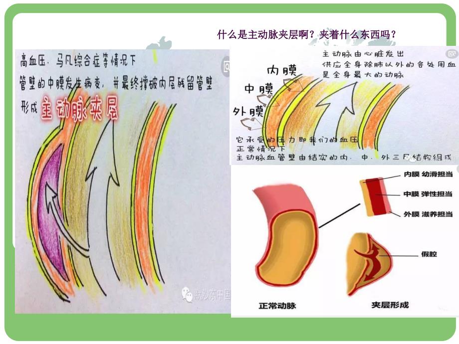 主动脉夹层的病例讨论ppt课件.ppt_第3页