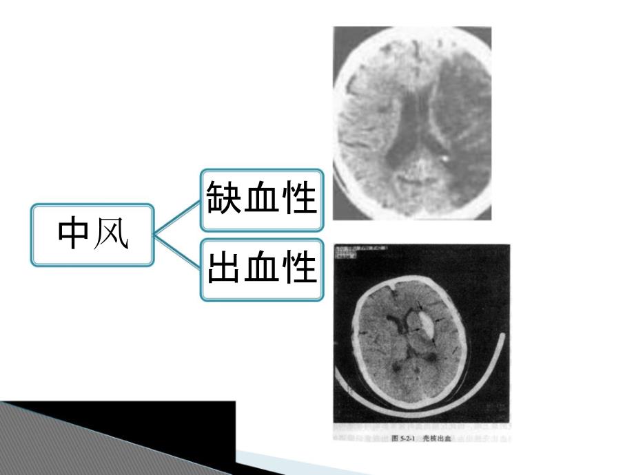 中风PPT课件.ppt_第3页