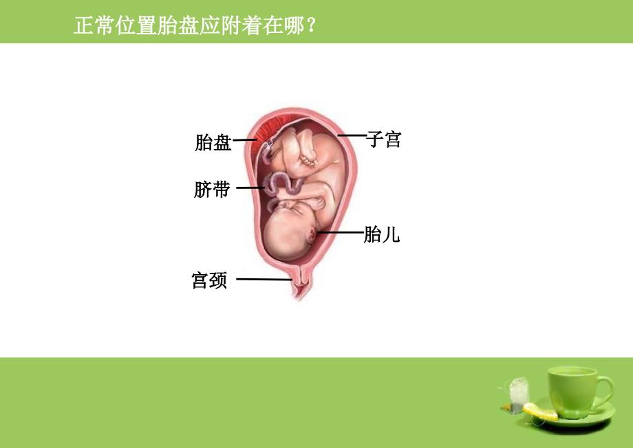 前置胎盘PPT课件.ppt_第2页
