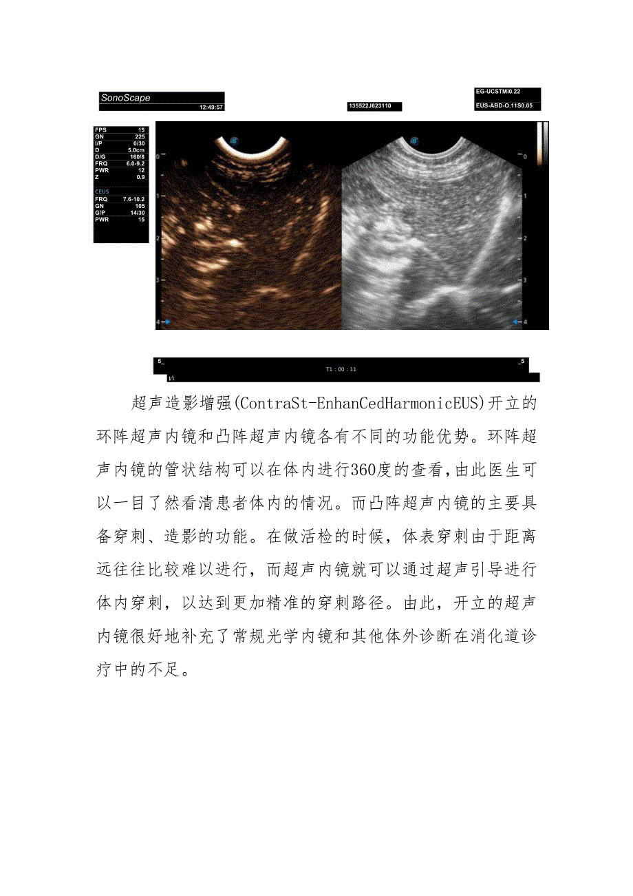 超声内镜临床效果优于其他体外诊断检查.docx_第3页