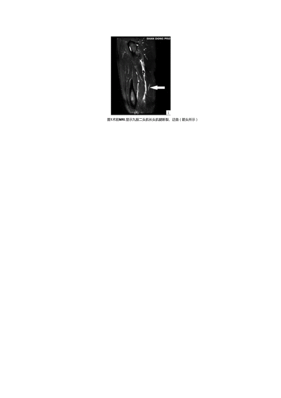 股二头肌长头肌腱断裂病例分析.docx_第2页