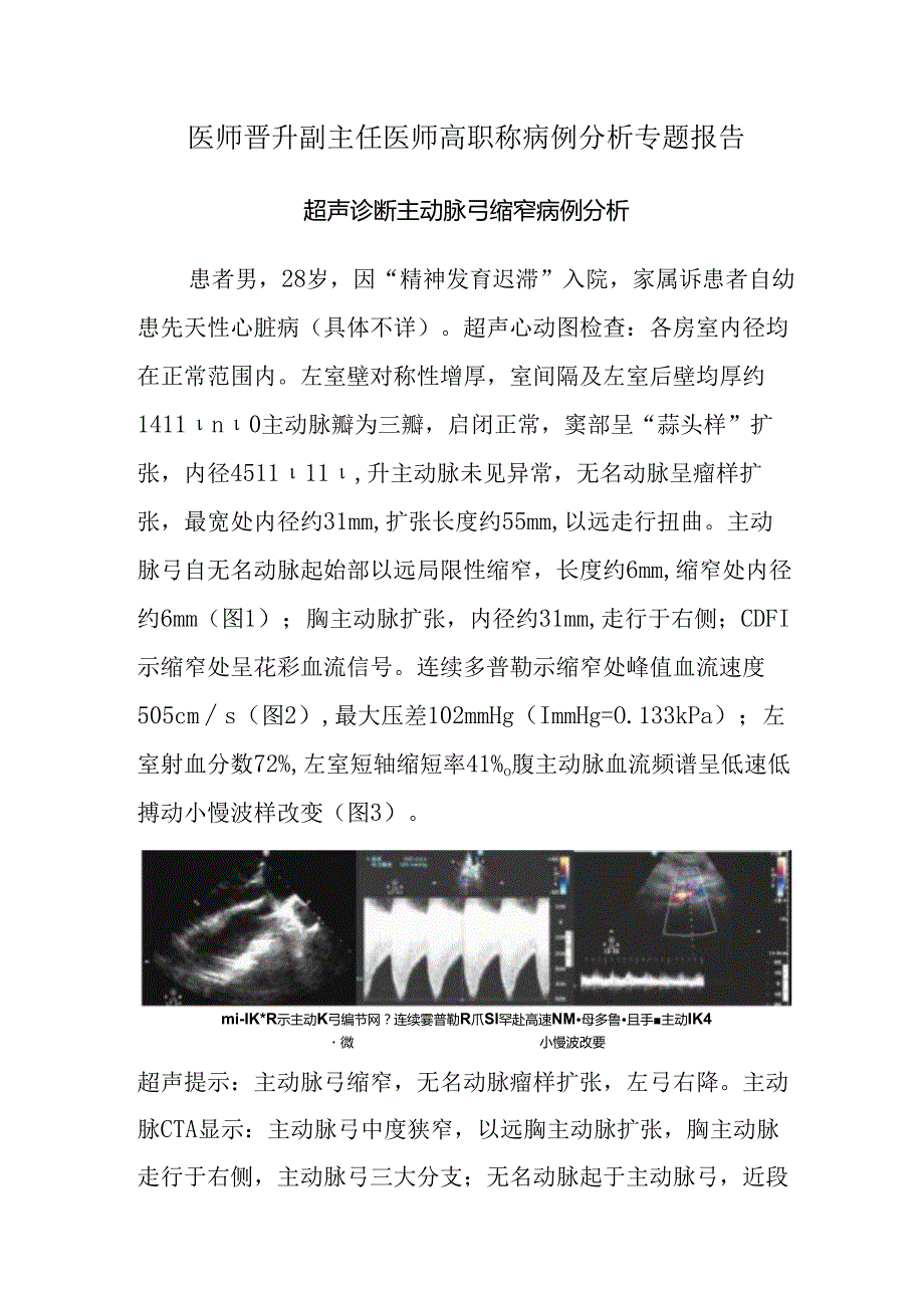 医师晋升副主任医师高职称病例分析专题报告（超声诊断主动脉弓缩窄）.docx_第1页