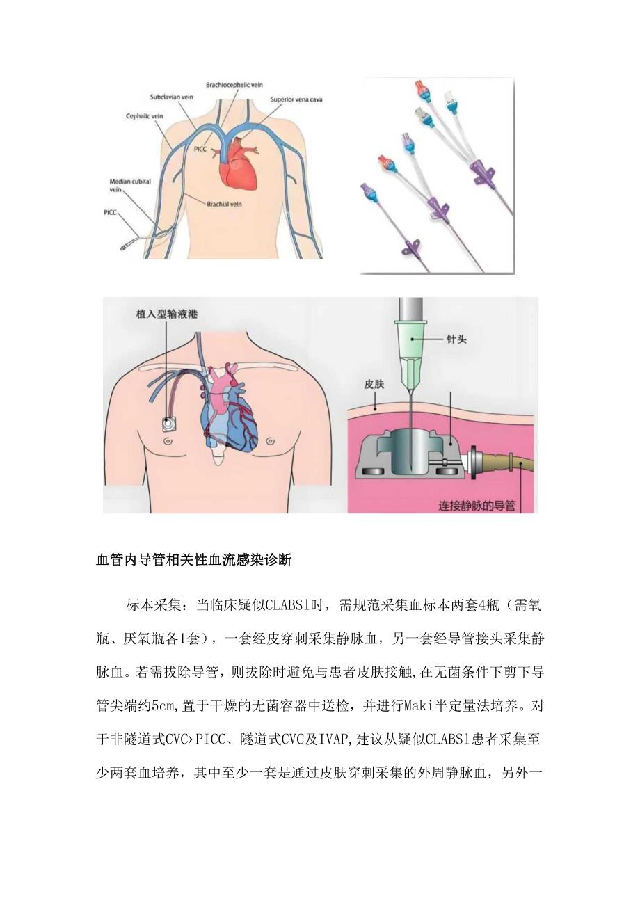 血管内导管相关性血流感染预防—感染诊断.docx_第2页