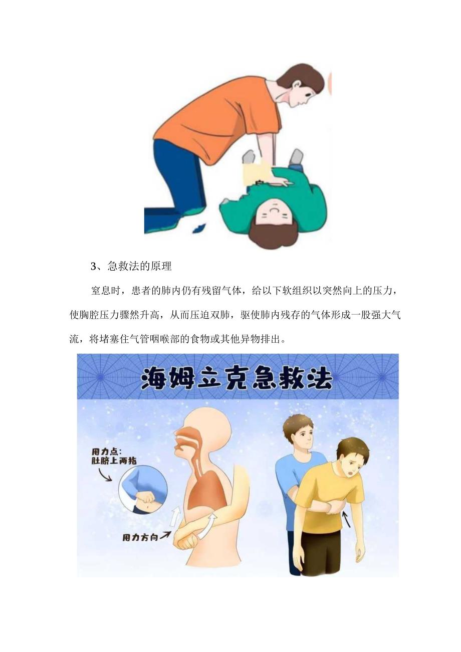 精神患者噎食急救手法详解.docx_第3页