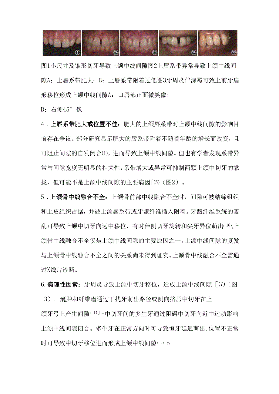 局部瓷贴面治疗上颌中线间隙的临床要点.docx_第3页