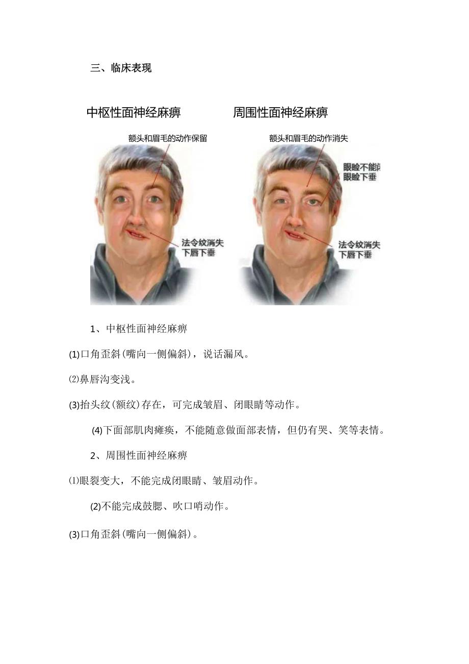 特发性面神经麻痹的康复治疗.docx_第3页