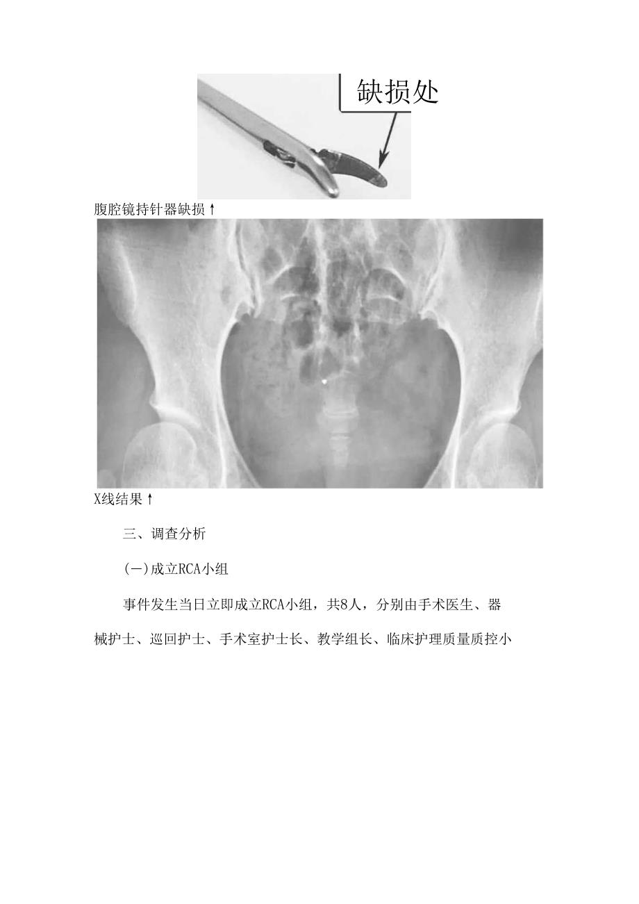 腹腔镜手术器械碎屑留在患者腹腔不良事件QC改善案例精析.docx_第3页