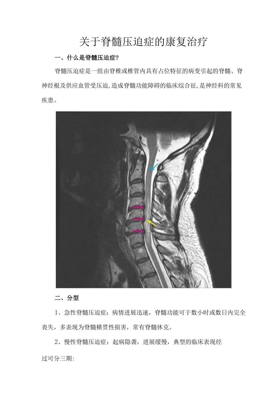 关于脊髓压迫症的康复治疗.docx_第1页